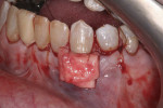 A double layer of ADM was secured over the root of tooth No. 22 using 4.0 chromic gut suture.