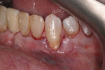 Incisions made from the distal of tooth No. 21 to the mesial of tooth No. 23.