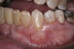 At 12 weeks, 100% root coverage, thicker gingiva, and a natural appearance were present.
