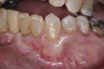 At 5 years (61 months), the complete root coverage and natural gingival contours were found to be stable.