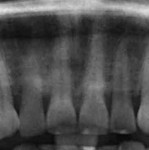 Pretreatment images of teeth Nos. 7 though 10.