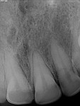 Pretreatment images of teeth Nos. 7 though 10.