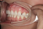 Patient also wanted the diastema between teeth Nos. 11 and 12 closed.