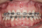 Orthodontics to intrude teeth Nos. 8 and 9, while also closing the diastema distal to No. 11.