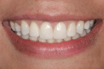 Smile healing 4 weeks after treatment.