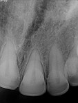 Pretreatment images of teeth Nos. 7 and 10.