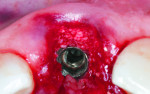 Fig 5. Particulate bone graft placed in the space between the implant and bone walls of the socket.