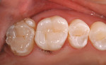 Figure 11  The completed restoration exhibiting natural esthetics. Note: the adjacent tooth was treated to finish the quadrant.