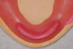 Fig 4. Mandibular thin wax rim.