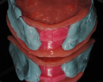 Fig 7. Denture bases held in CR position by the bite registration material.