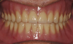 Fig 10. Delivery of finished dentures.