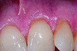 Fig 6. Pretreatment sensitivity site, tooth No. 9 cervical.