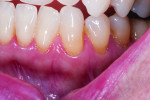 Fig 7. Pretreatment sensitivity site, tooth No. 22 cervical.