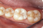 Figure 6  The postoperative photograph shows the final result.