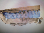 Fig 9 and Fig 10. The dental technologist was able to recognize malocclusion and resolve it prior to committing to the expense in time and labor involved with fabricating the crowns incorrectly.