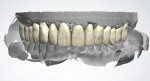 Fig 11. The teeth are manipulated to achieve the desired function.