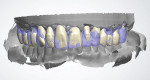 Fig 12. The provisional double scan is used to align the newly designed teeth to have similar shape, size, and orientation to that of the temporaries.