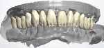 Fig 15. The anterior incisals were cutback in the software and prepared to receive micro-layering with IPS e.max overlay porcelain.