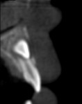Cross-sectional cut showing impacted tooth No. 6. Note resorption of apex of tooth No. 7.