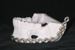 Stereolithographic model of ameloblastoma, left mandible, 19-year-old woman. Note pre-bent
reconstruction plate.