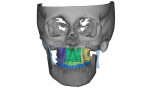 Virtual simulation plan of planned maxillary and mandibular osteotomies, patient case in Figure 8.