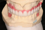 Diagnostic wax-up, maxilla, patient case in
Figure 10.