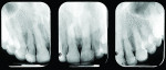 Fig 3. Preoperative anterior radiographs.