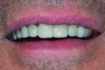 Fig 6. Extraoral view of patient’s provisional
restorations for teeth Nos. 5 through 12. The one-piece provisional was fabricated using Integrity® Multi-Cure Crown and Bridge Material (Dentsply Sirona Restorative) and cemented with Integrity® TempGrip™ Temporary Crown & Bridge Cement (Dentsply Sirona Restorative).