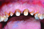 Fig 4. Completed full-coverage preparations on teeth Nos. 5 through 12. A chamfer finish line was used, where up to 2 mm of reduction was achieved. Note the dark, striated appearance of the prepared teeth.