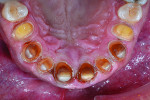 Fig 5. Occlusal view of completed full-coverage preparations on teeth Nos. 5 through 12.