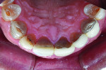 Fig 2. Occlusal view of preoperative condition for teeth Nos. 5 through 12.