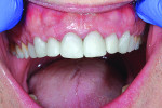 Fig 9. Try-in stage of Celtra Duo (ZLS) crowns for teeth Nos. 5 through 12. At this visit, tooth shape and esthetics were adjusted to meet the patient’s esthetic requests. In addition, interproximal contacts and occlusion were adjusted. Celtra Duo (ZLS) can be milled, polished, and inserted for flexural strength of approximately 210 MPa, or fired to achieve a maximum strength of approximately 370 MPa. In this case, the restorations were stained using Celtra Duo Universal Stain LF Violet to help block the darkness of the stump coming through the bicuspids. After that, a universal stain was used for cervical third, the Celtra Duo Incisal Stain i1 for the incisal third, and Celtra Duo Light Violet and Celtra Duo White stains
were used to characterize the crowns and further enhance final esthetics. The crowns were fired as per manufacturer’s recommendations in a Programat CS2 oven (Ivoclar Vivadent).