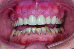 Fig 12. Postoperative view of completed Celtra Duo (ZLS) crowns on teeth Nos. 5 through 12.