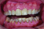 Fig 7. Intraoral view of patient’s provisional restorations for teeth Nos. 5 through 12, after tissue healing.