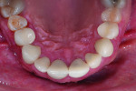 Fig 13. Postoperative occlusal view of completed Celtra Duo (ZLS) crowns on teeth Nos. 5 through 12.