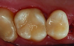 Fig 10. The final restoration shows a natural-looking tooth restored with materials that promote regeneration and long-term health.