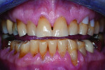 Fig 8. The patient’s definitive occlusal therapy included equilibration and composite bonding of the damaged teeth to provide appropriate anterior guidance in centric relation. This
image shows the pretreatment condition.