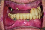 Fig 1. Frontal view of patient, a 91-year-old man who lost his maxillary FPD, showing the
nonrestorable root remnants of the upper left canine and lateral. Implant No. 4 had a custom
abutment screwed to the implant. Given his medical history, age, and financial limitations, the patient decided to have all the remaining implant-supported FPDs and crowns removed and receive an ISO retained by three Locator R-Tx abutments.