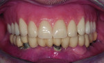 Fig 4. An immediate complete denture was delivered after the extraction of teeth remnants Nos. 6 and 7 and the removal of all remaining implant- supported FPDs and crowns.