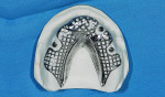 Fig 7. Maxillary definitive cast with locator R-Tx abutment analogues. After virtual design of the metal framework for the ISO was done and printed resin pattern was made ready to invest and cast, wax rims were added to the removable partial denture framework (shown here), tried in the patient’s mouth and adjusted, and an interocclusal record was made.