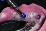 Fig 10. After a grinding bur from the Chairside® Denture Prep & Polish Kit (ZEST Anchors) was used to remove the excess of acrylic around the denture attachment housing, the retention insert tool was used to place the low-retention insert in the denture attachment housings (shown here). To facilitate the removal and insertion of the definitive overdenture, a low-retention insert and two zero-retention inserts would be placed in the denture attachment housings.