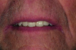 Fig 13. Esthetic appearance of the definitive ISO.