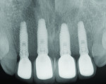 Fig 16. Periapical radiographs taken approximately 2 months after placement of the final prostheses showed excellent maintenance of bone level surrounding all four implant fixtures.