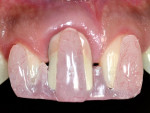 Fig 3. Acrylic template used to record the improvement of implant-related gingival recession.