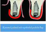 Fig 5 and Fig 6. Schematic illustration of the double-papillary flap approximation (Fig 5) combined with extended subepithelial pedicle (Fig 6) from the palate to treat Class II gingival recession.