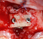 Fig 11. A monocortical graft was stabilized with
two micro titanium screws to treat the preexisting osseous defect.
