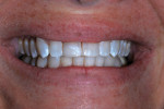 Two months after renewed restoration, dry tooth surface showed white enamel dysmineralization.
