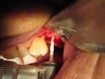Standard implant drill 1 mm to 2 mm below sinus.