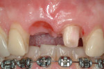 Example of case type 1: Patient is missing tooth No. 8 with favorable dental, soft tissue,
and bone anatomy.
