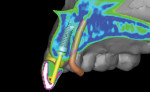 3D case planning completed with single-tooth scanning appliance.